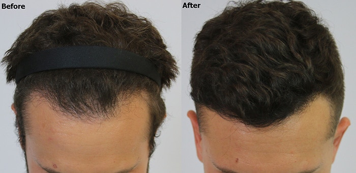 Hairline Restoration - 1208 FUE Hair Grafts - AlviArmani - Hair Transplant  Los Angeles
