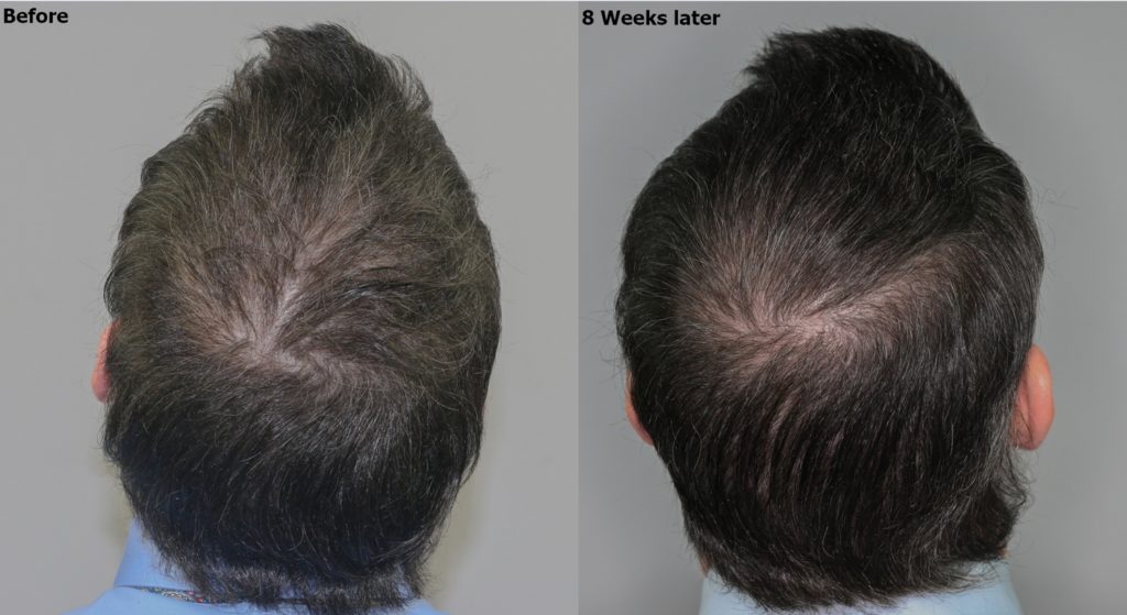 Exosome Therapy - Alvi Armani - Hair Transplant Los Angeles