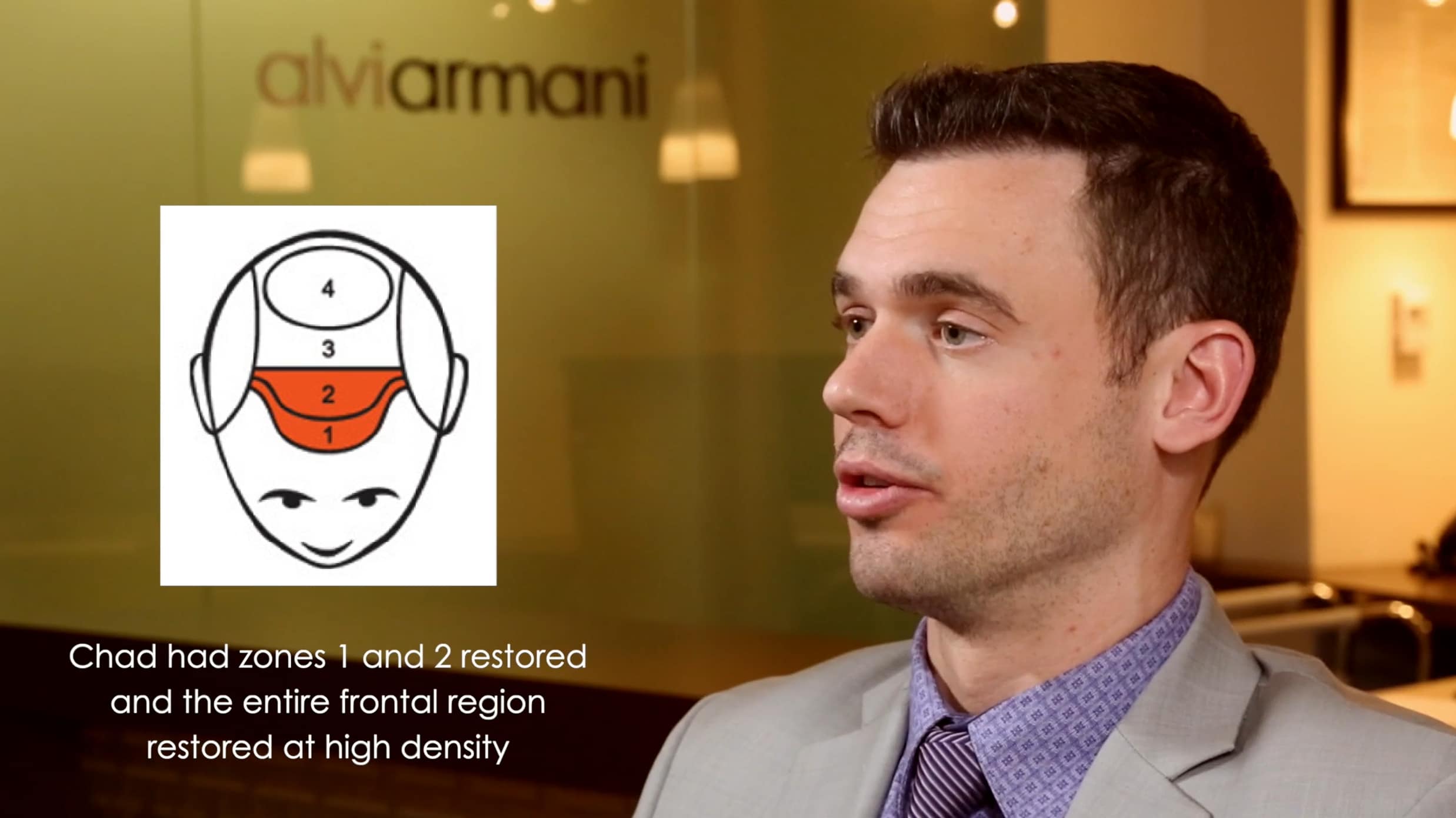 Chad's 3,100 graft result with AlviArmani - AlviArmani - Hair Transplant  Los Angeles