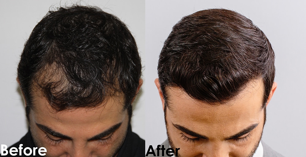 FUE Hairline Hair Restoration - AlviArmani - Hair Transplant Los Angeles