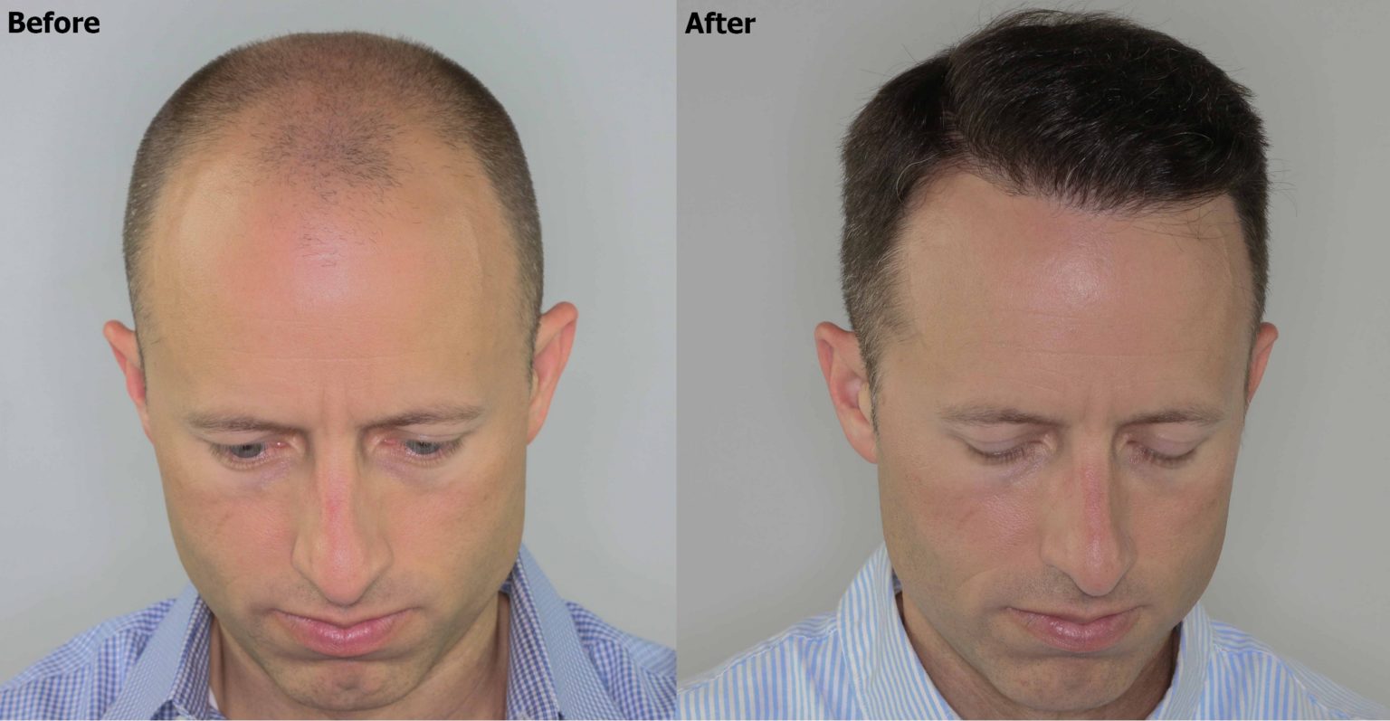 Norwood 5 Hair Transplant Result - AlviArmani - Hair Transplant Los Angeles