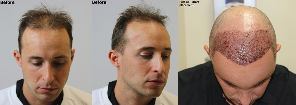 High Density Hairline Result - Alvi Armani - Hair Transplant Los Angeles