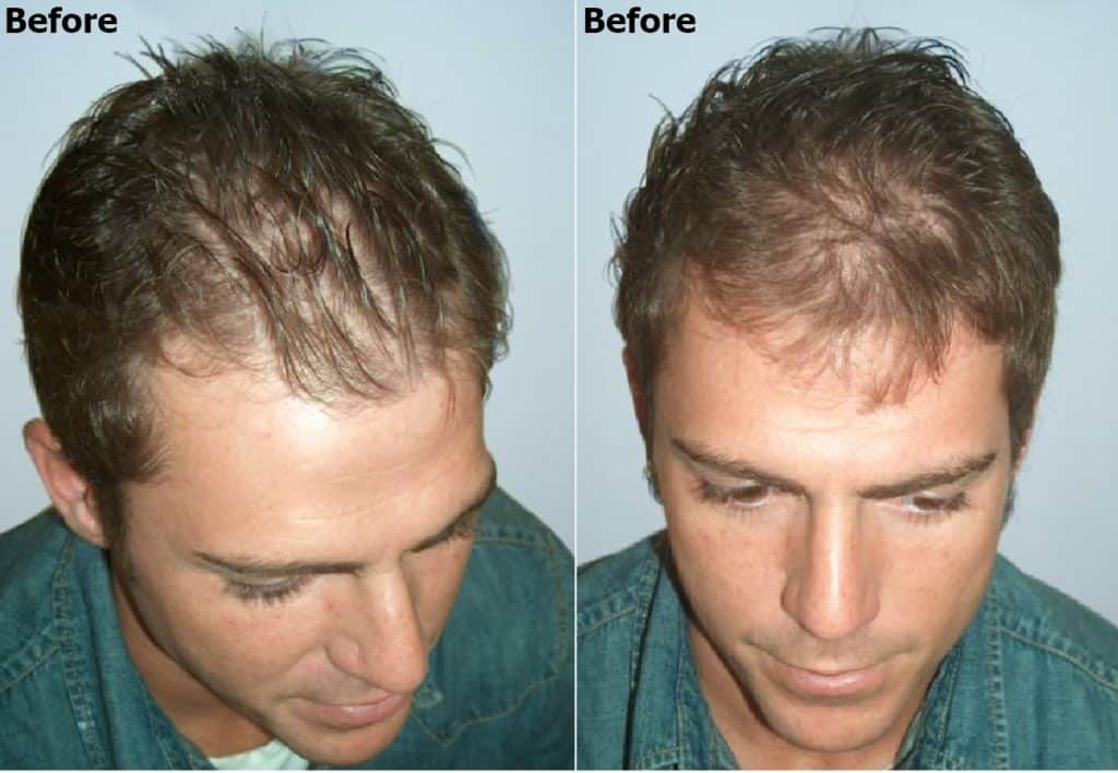 3000 Graft Hair Restoration Alvi Armani Hair Transplant Los Angeles 9488