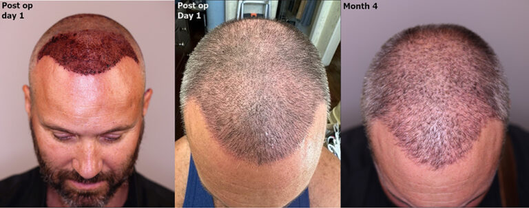 New 3000 Graft Fue Hair Restoration Alvi Armani Hair Transplant Los Angeles 4903